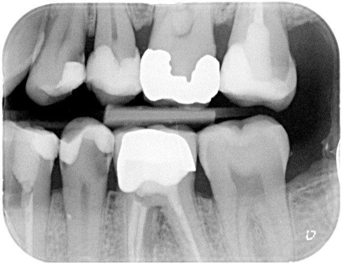 Dental bitewing radiograph