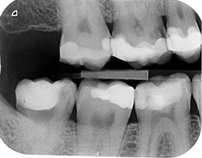 Bitewing radiograph — a bright filling on one molar, caries on another
