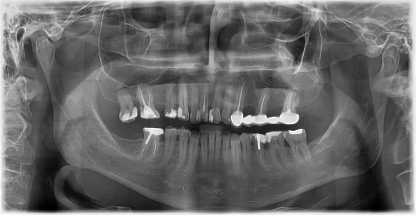 Panoramic dental X-ray